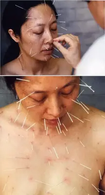 《99针》何成瑶